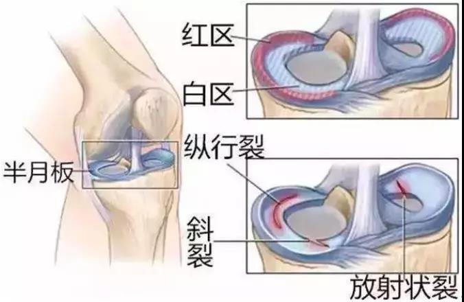 交叉韧带康复训练进度_交叉韧带康复科一天多少钱_前交叉韧带康复训练图